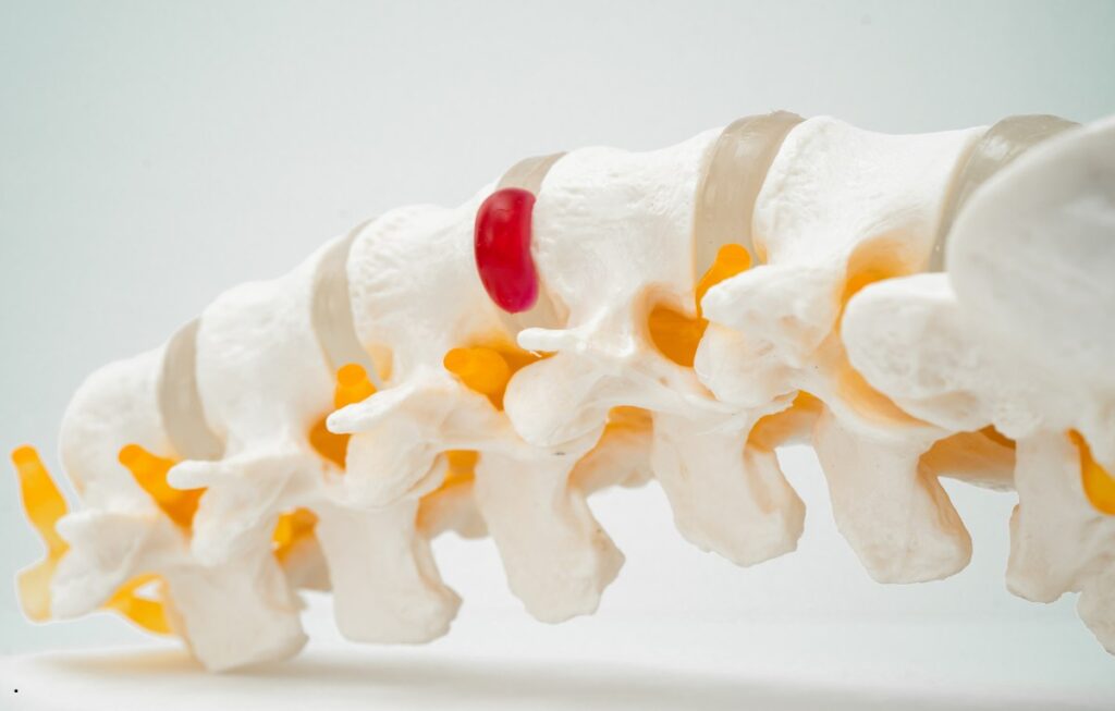 Herniated Discs Treatment