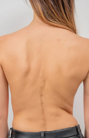 Back view of a woman showing visible spinal curvature, indicative of scoliosis, emphasizing the need for chiropractic care and treatment options for scoliosis relief.