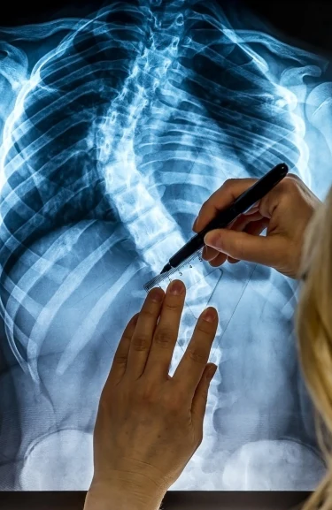 X-ray image of a spine being analyzed, highlighting scoliosis curvature, with a hand using a pen for annotation.
