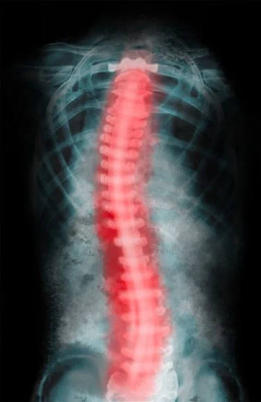 X-ray image of a human spine highlighted in red, illustrating spinal alignment issues related to scoliosis, relevant to chiropractic care and treatment options for spinal conditions.
